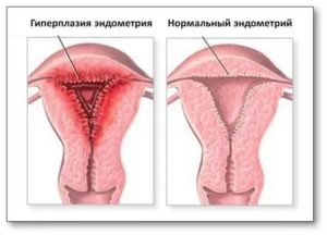 Сколько идут месячные после чистки гиперплазии эндометрия