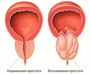 Лечение хронического трихомонадного простатита