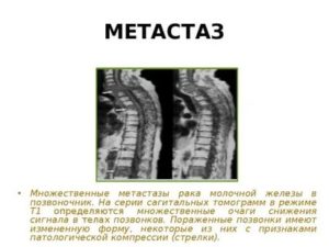 Как лечить метастазы в позвоночнике при раке молочной железы