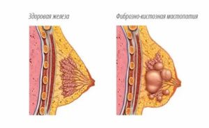 Фиброзно аденоматозная мастопатия мрт