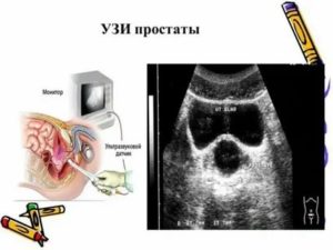 Как делается узи почек и узи предстательной железы