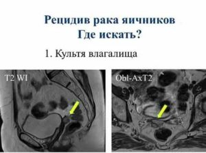 Как проявляется рецидив при раке яичника