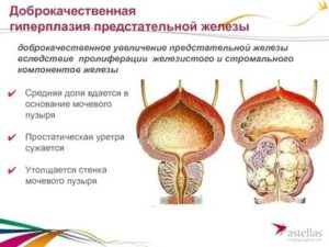 Рост латеральных долей предстательной железы