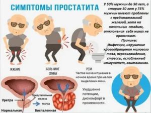 Как и сколько пить воду при аденома предстательной железы