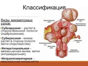 Интерстициальный узел по задней стенке матки при климаксе