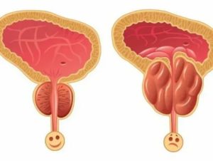 Как лечить когнитивный простатит