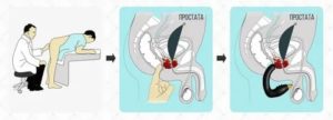 Как делать массаж промежности при простатите
