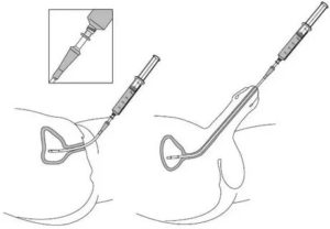 Инъекционное введение препаратов в уретру и пещерные тела