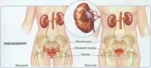 Может ли цистит или пиелонефрит передаваться половым путем