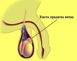 Что такое киста придатка правого яичка у мужчин