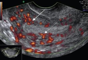 Узи допплерометрия сосудов эндометрия