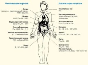 Что показывает анализ на онкомаркеры в гинекологии