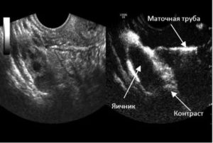 Расширенная маточная труба на узи