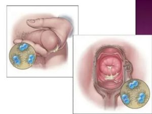 Что такое уреаплазменный цервицит