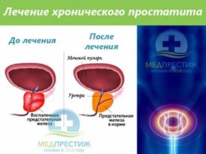После лечения хронического простатита нет семяизвержения