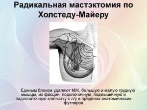 Операция при раке молочной железы по маддену