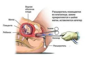 Сколько времени могут идти месячные после выскабливания