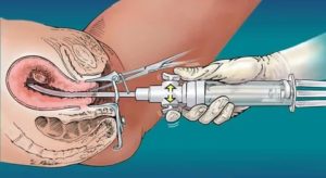Можно ли делать гистероскопия в первый день месячных