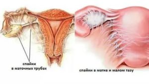 Как убрать спайки на маточных трубах без операции народные средства