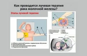 Сколько длится сеанс лучевой терапии при раке молочной железы