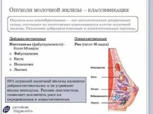 Может ли опухоль молочной железы быть доброкачественной опухоли