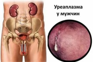Можно вылечить уреаплазмоз сафоцидом