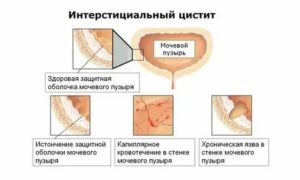 Что такое цистит новобрачных