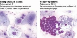 Сапрофитная микрофлора простаты