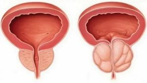 Может ли простатит повлиять на здоровье женщины