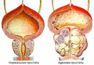 Предстательная железа у мужчин увеличена в два раза что это значит