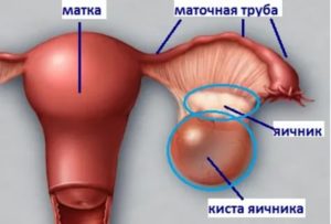 Как удаляют кисту яичника у новорожденных девочек