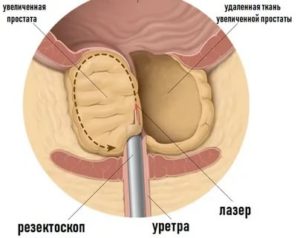 Лазерная энуклеация при доброкачественной гиперплазии предстательной железы