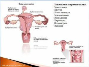 Можно ли пользоваться тампонами при миоме во время месячных