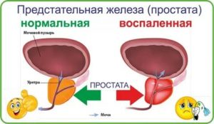 Симптомы простатита у женщин симптомы и лечение