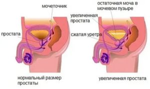 Остаток мочи в мочевом пузыре при простатите