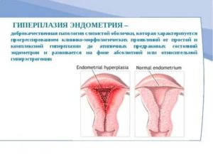 В чем разница между эндометриозом и гиперплазией эндометрия