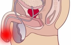 Мне 23 года у меня хронический простатит