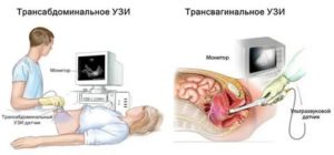 Если гинеколог отправил на узи что это значит