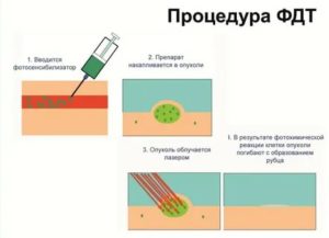 Фотодинамическая терапия при лечении рака шейки матки