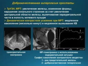 Признаки хронического простатита гиперплазия периуретральных желез