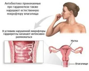 Можно ли забеременеть после гарднереллеза