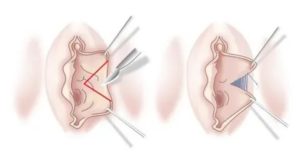 Как называется операция по уменьшению влагалища