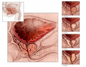 Как лечить аденому простаты по методу шевченко