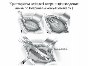 Как делают операцию по низведению яичка