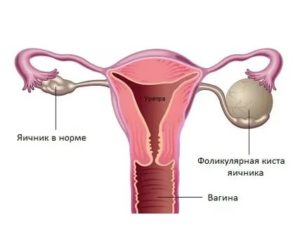 Может ли быть температура при фолликулярной кисте яичника