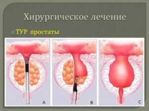 Трансуретральная инцизия предстательной железы это