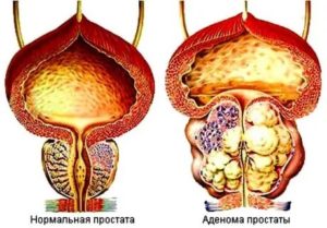 Может ли аденома простаты перерасти в злокачественную опухоль