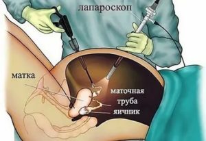Можно ли есть шоколад после операции на яичники