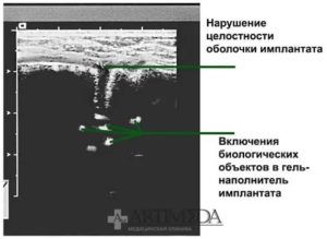 Узи заключение молочной железы с имплантами