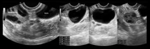 Нечеткие контуры яичника на узи причины